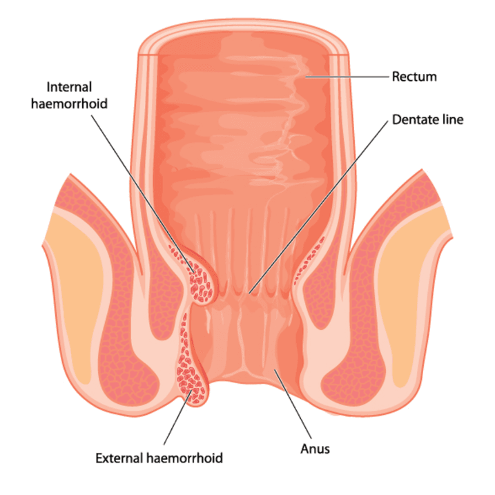 पाइल्स (Piles)